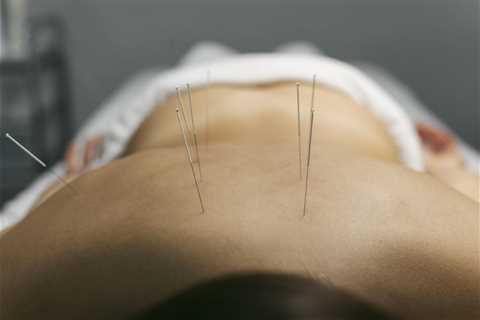ACUPUNCTURE FOR STRESS AND ANXIETY RELIEF